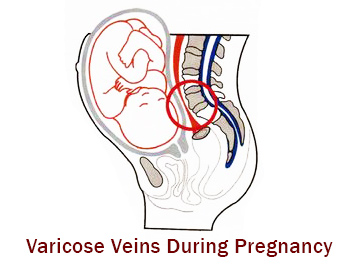 Varicose veins during pregnancy
