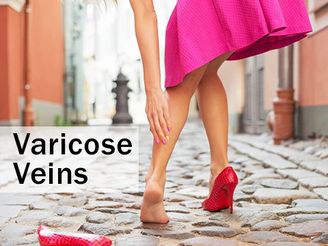 Varicose veins