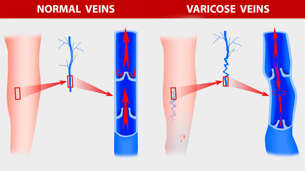 varicose veins