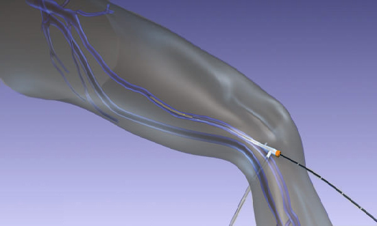 Endovenous Radiofrequency Ablation