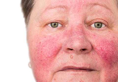 rosacea