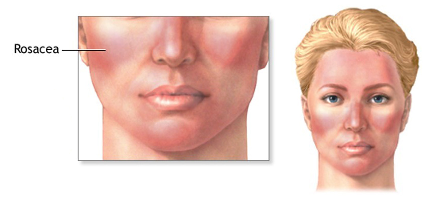 rosacea