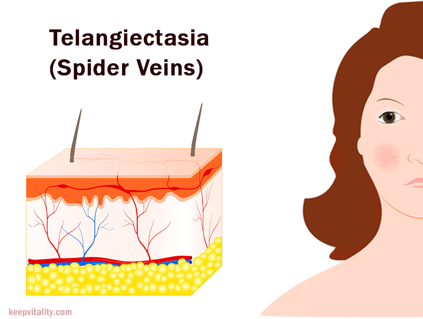Telangiectasia (Spider veins)