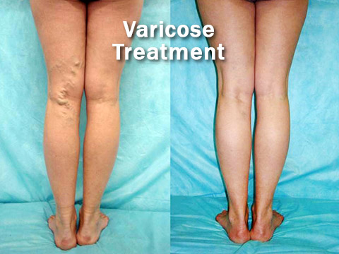 Varicose veins treatment