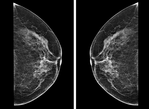 mammogram