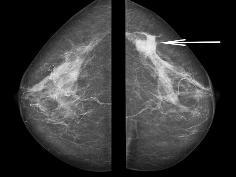 Breast cancer mammogram