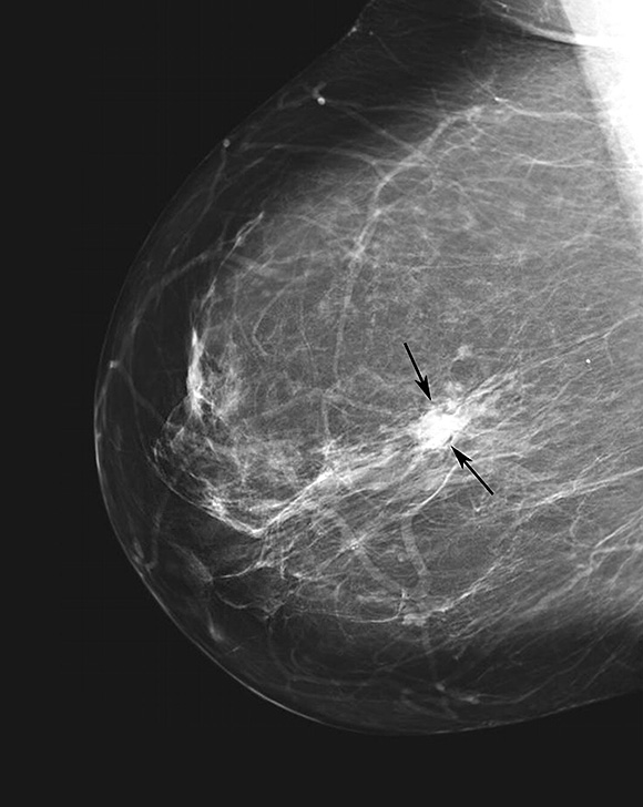 Ductal carcinoma mammogram