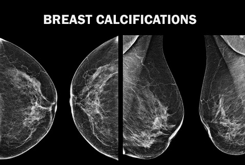 Breast calcifications