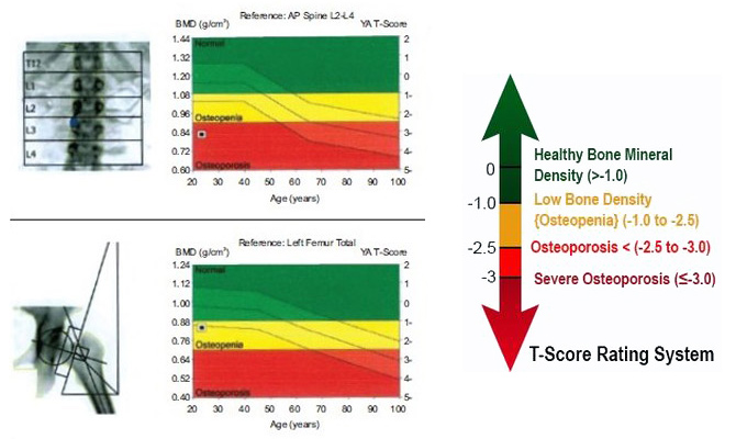 Dexa Scan Numbers Chart