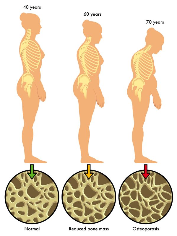 osteoporosis posture