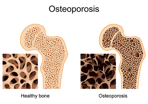 Osteoporosis