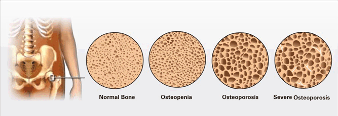 osteoporosis bones