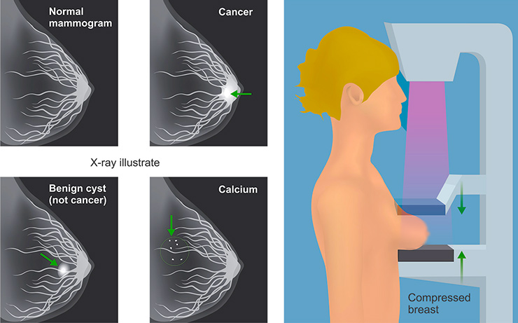 mammography