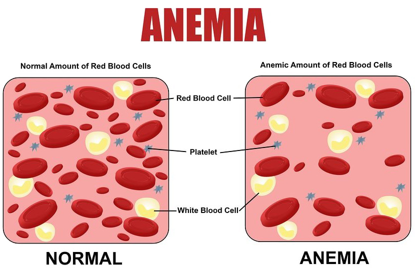 Anemia