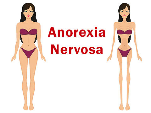 Anorexia nervosa