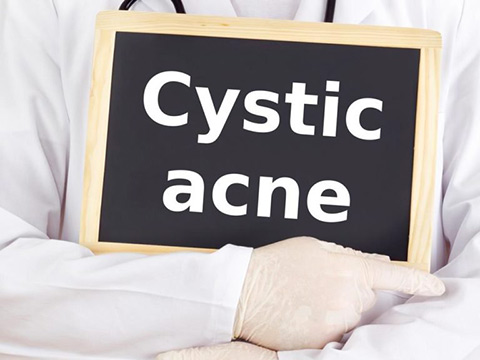 Cystic acne