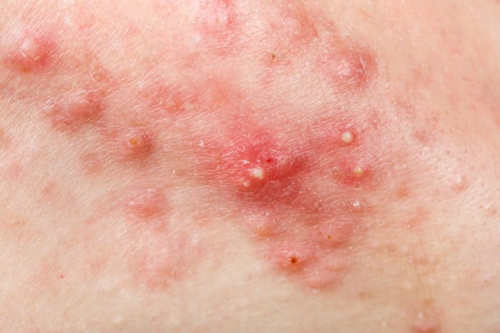 Cystic acne photo