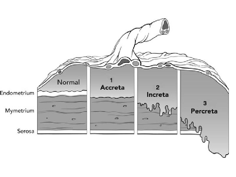 Placenta accreta