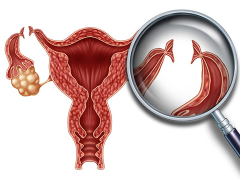 tubal ligation