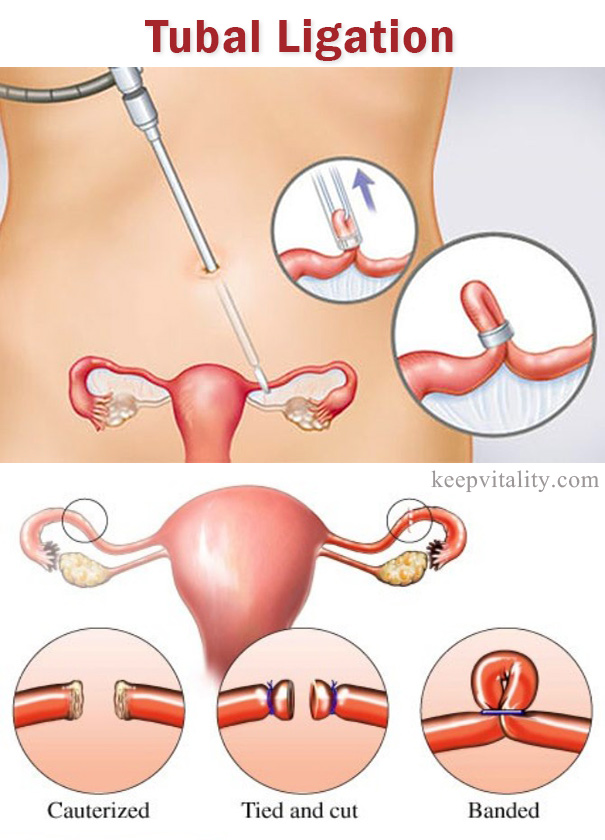 Tubal ligation procedure