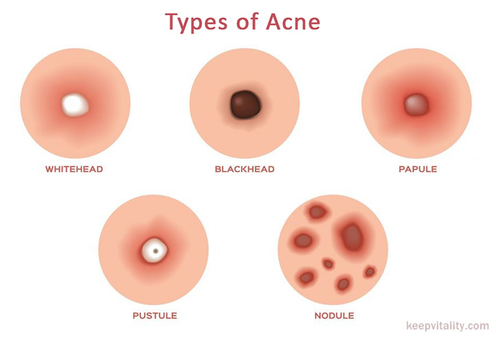 types of acne