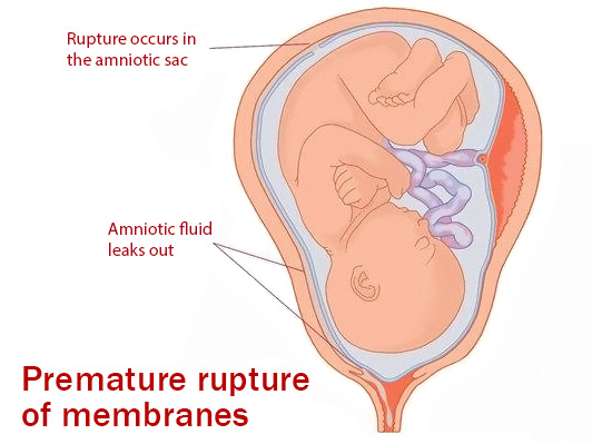 Premature rupture of membranes (PROM)