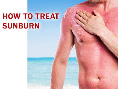 How to treat sunburn