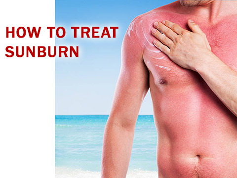 how to treat sunburn