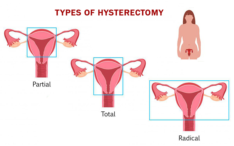 types of hysterectomy